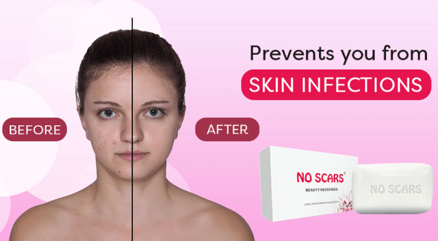 good scar removal Soap