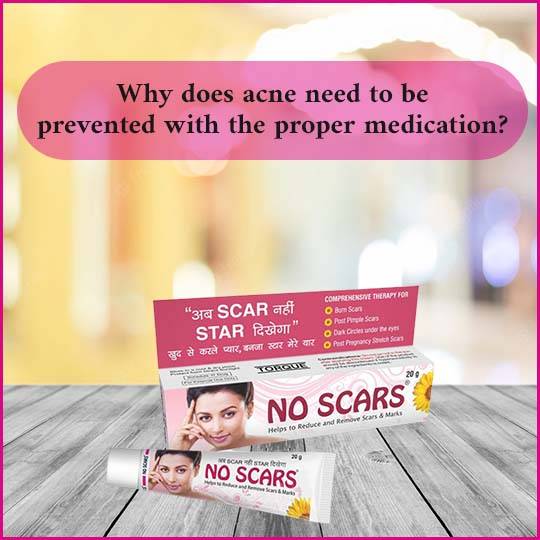 no scars cream for acne scars