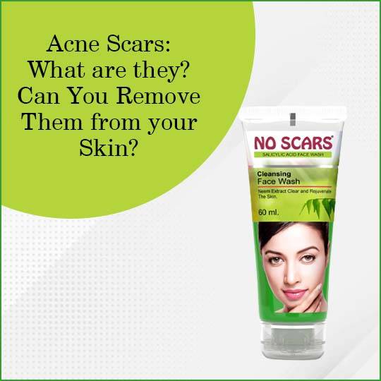 https://www.noscars.co.in/wp-content/uploads/2022/05/Acne-ScarsWhat-are-they-Can-You-Remove-Them-from-your-Skin.jpg