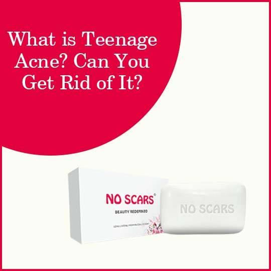 https://www.noscars.co.in/wp-content/uploads/2022/05/What-is-Teenage-Acne-Can-You-Get-Rid-of-It.jpg